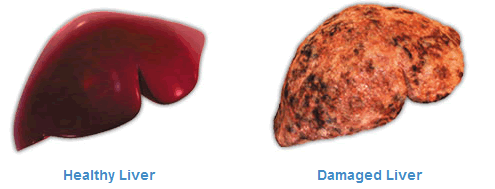 damaged_liver